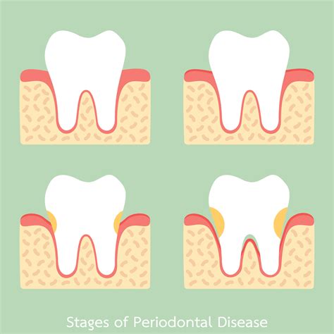 Stages of Gum Disease | Learn How to Prevent & Treat Periodontal
