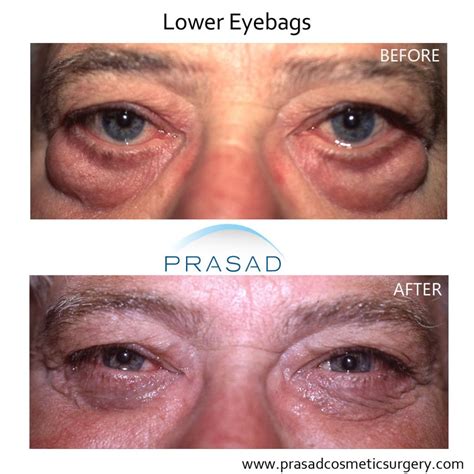 Under Eye Bag Surgery Prasad Cosmetic Surgery New York