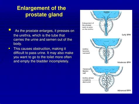 Ppt Benign Prostatic Hyperplasia Powerpoint Presentation Free Download Id