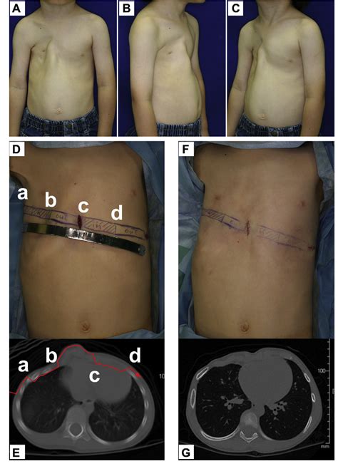 Figure 1 From Correction Of Complex Chest Wall Deformity In Polands