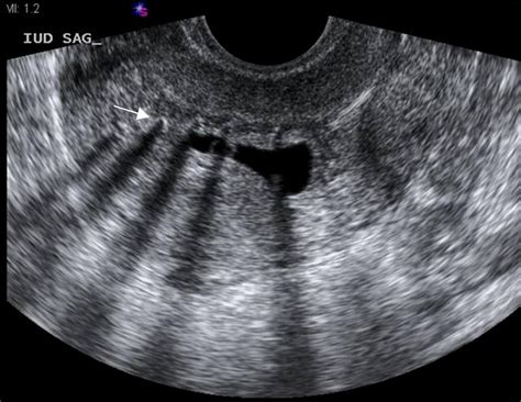 Intrauterine Devices In Early Pregnancy Findings On Ultrasound And