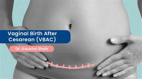 Vaginal Birth After Cesarean VBAC A Consideration For Safe Delivery