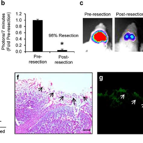 Fluorescence Guided Gbm Resection And Validation By 5 Ala A