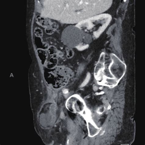 Ct Coronal Scan Right Femoral Hernia Containing Liquid Effusion And An
