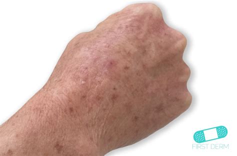 Itchy Red Bumps And Common Causes First Derm Blog