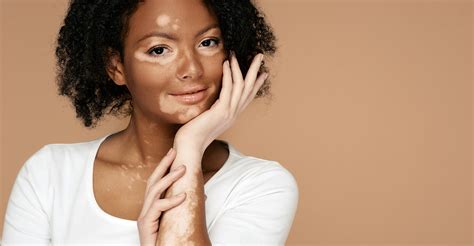 Vitiligo Clear Dermatology