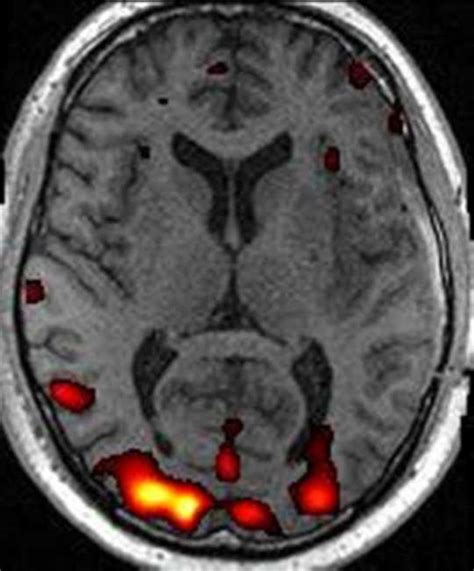 Patient With Left Temporal Lobe Tumor Blk Brocas And Wernickes