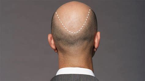 In vielen fällen kann den patienten mit einer haartransplantation geholfen werden, was oftmals mit einem deutlichen zuwachs an selbstbewusstsein einhergeht. Methoden und Ergebnisse von Haartransplantationen ...