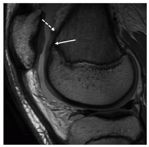 Physeal Sparing Medial Patellofemoral Ligament Reconstruction