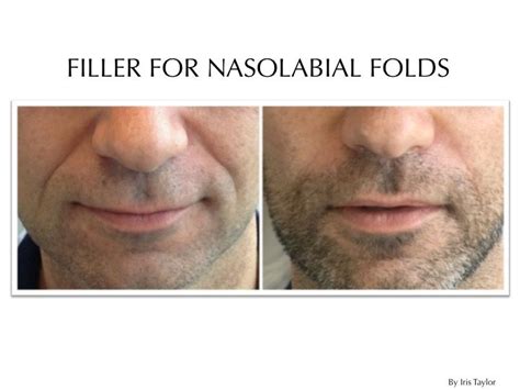 Filler For Men Dermal Fillers Injectables Fillers Nasolabial Folds