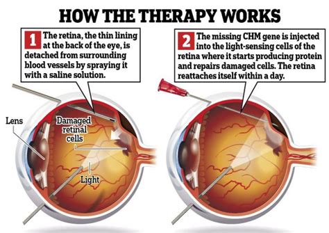 Gene Injection Found To Help Restore The Sight Of People With Inherited
