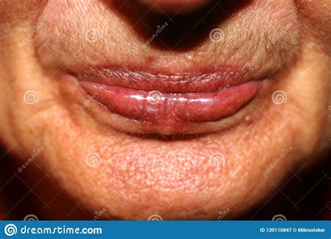 Lips With Lowered Corners Wrinkles On The Lips Stock Image Image Of