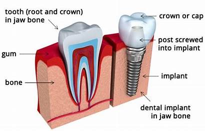 Dental Implant Implants Tooth Problems Injury Solve