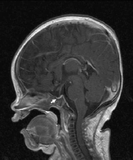 T1 Weighted Image Of Brain Magnetic Resonance Imaging Sagittal View