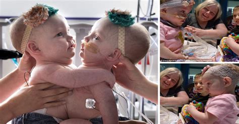 Formerly Conjoined Twins Embrace Remarkable New Beginnings After A High гіѕk Separation ѕᴜгɡeгу