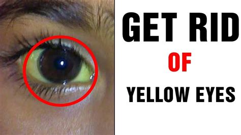How To Get Rid Of Yellow Eyestreatments And Natura Remedies Youtube