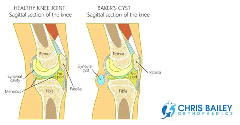 The Bakers Cyst What Is It And Will It Go Away Chris Bailey