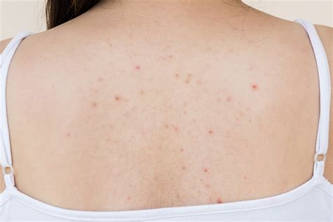 Back Acne Or “bacne” The Guide To At Home Vs In Clinic Treatments