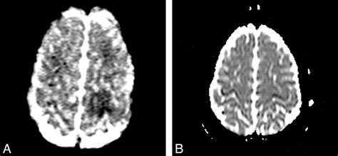 Diffusion Weighted Mr Imaging Of An Acute Venous Stroke Case Report