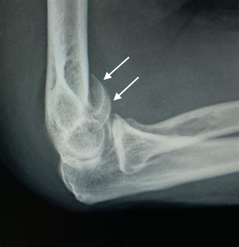 Treatment Of Distal Humerus Fractures Cancer Therapy Advisor