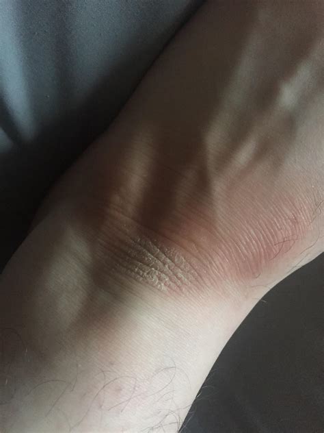 Had This Patch Of Skin On My Ankle For Years 24m What Is It Doesn