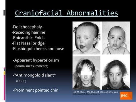Sotos Syndrome Genetics Radiology Craniofacial Abnormalities