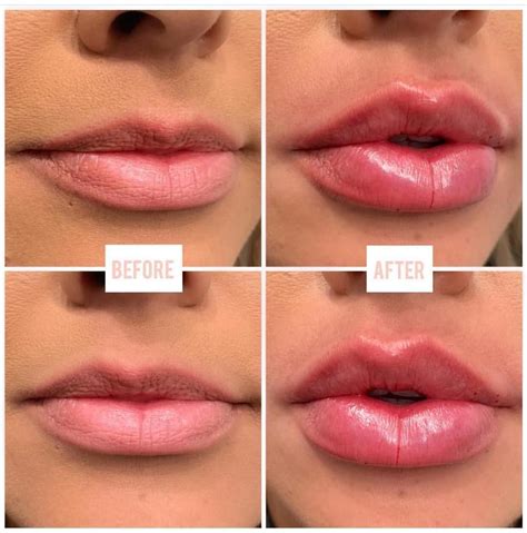 Sev Injections On Instagram Lips By Linasev 1 Full Syringe Of