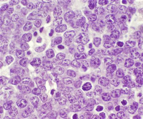 Diffuse Large B Cell Lymphoma Dlbcl Anthology Diagnostics