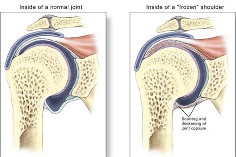 Frozen shoulder develops slowly, in three distinct phases. Signs And Symptoms Of Frozen Shoulder | Homemade ideas ...
