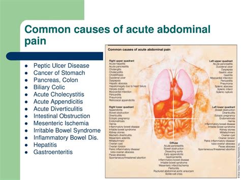 PPT Approach To The Patient With Acute Abdominal Pain PowerPoint Presentation ID