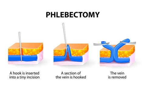Phlebectomy Procedure For Removing Varicose Veins