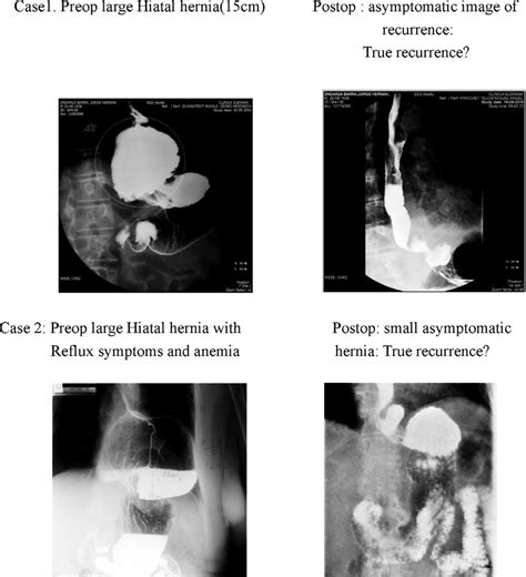 Cases With Large Preoperative Hiatal Hernias Preoperative And