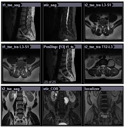 Schwannoma Of Lumbar Spine A Medical Ca Enliven Archive