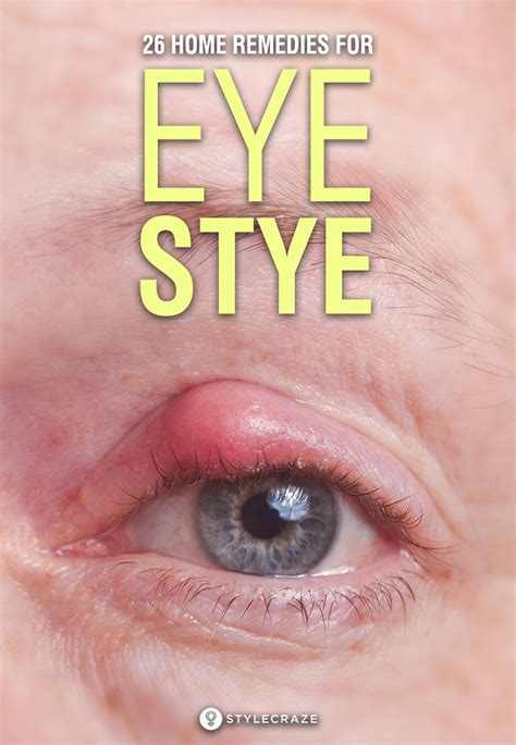26 Effective Home Remedies To Get Rid Of Eye Stye