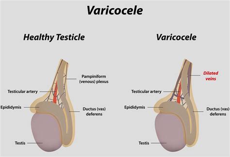 Diagrammatic Representation Of Varicocele
