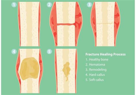 Fractures And Healing Process Vectors Download Free Vector Art Stock Graphics And Images