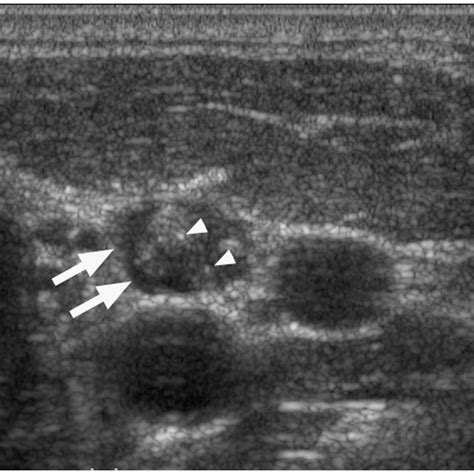 Grey Scale Sonogram Showing A Metastatic Lymph Node From Papillary