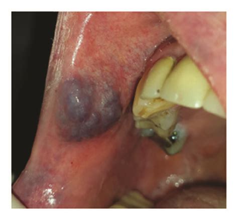 Lobulated Hemangioma Involving The Right Upper Lip Download