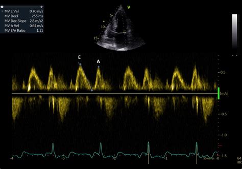 Early Echocardiographic Predictors For Atrial Fibrillation Propensity
