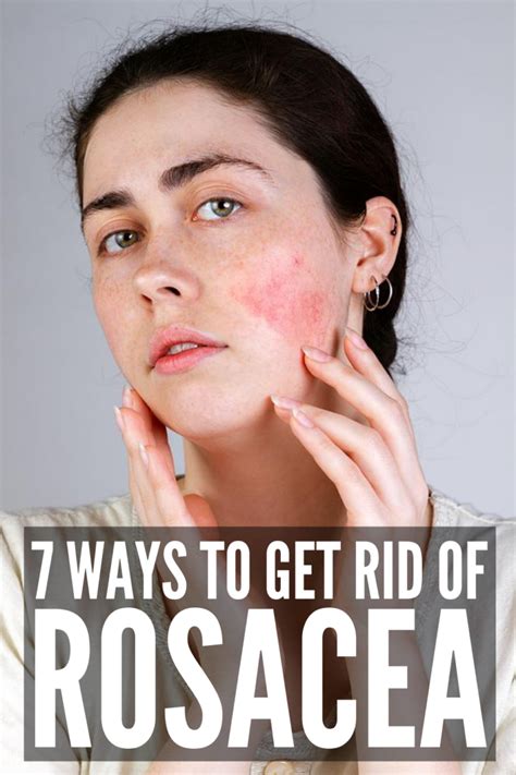 How To Get Rid Of Rosacea 7 Rosacea Remedies That Work Rosacea Rosacea Remedies Rosacea Redness