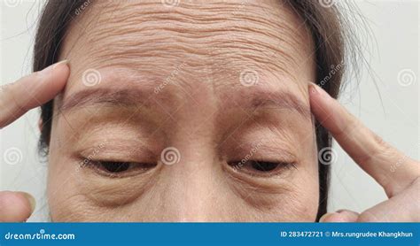 The Flabbiness And Wrinkle On Forehead Lines Stock Image Image Of