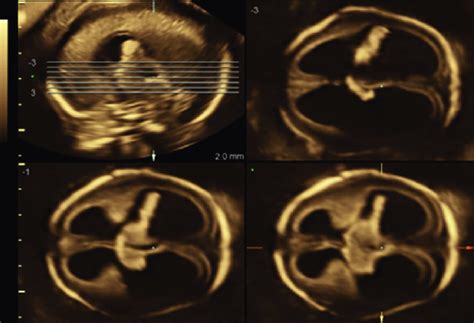 Tomographic Ultrasound Image Of Ventriculomegaly At 21 Weeks Of