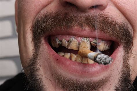 What Smoking Does To Your Teeth Images And Photos Finder