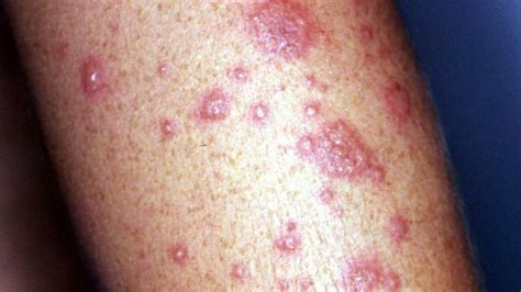 What To Know About Erythema Multiforme