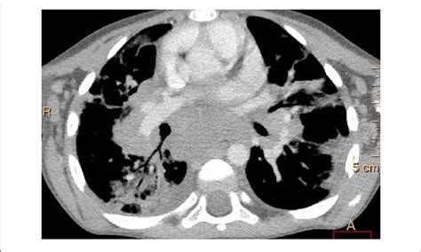 Contrast Enhanced Lung Computed Tomography Soft Tissue Window
