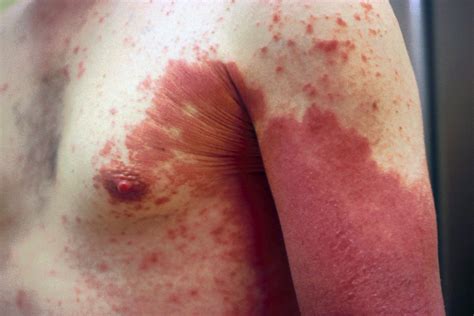 Psoriasis How Does It Affect Your Health