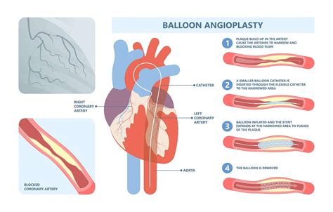Difference Between Angiography And Angioplasty Dr Raghu