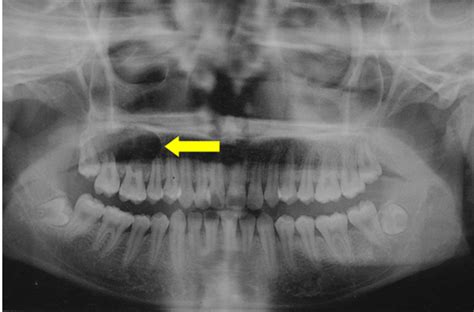 Full Text Glandular Odontogenic Cyst Of Posterior Maxilla A Rare