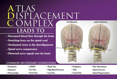 Atlas Correction Vs Traditional Manipulation Precision Chiropractic