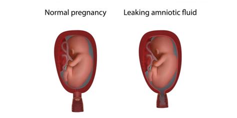 Leaking Amniotic Fluid In Pregnancy What Does It Mean Pristyn Care